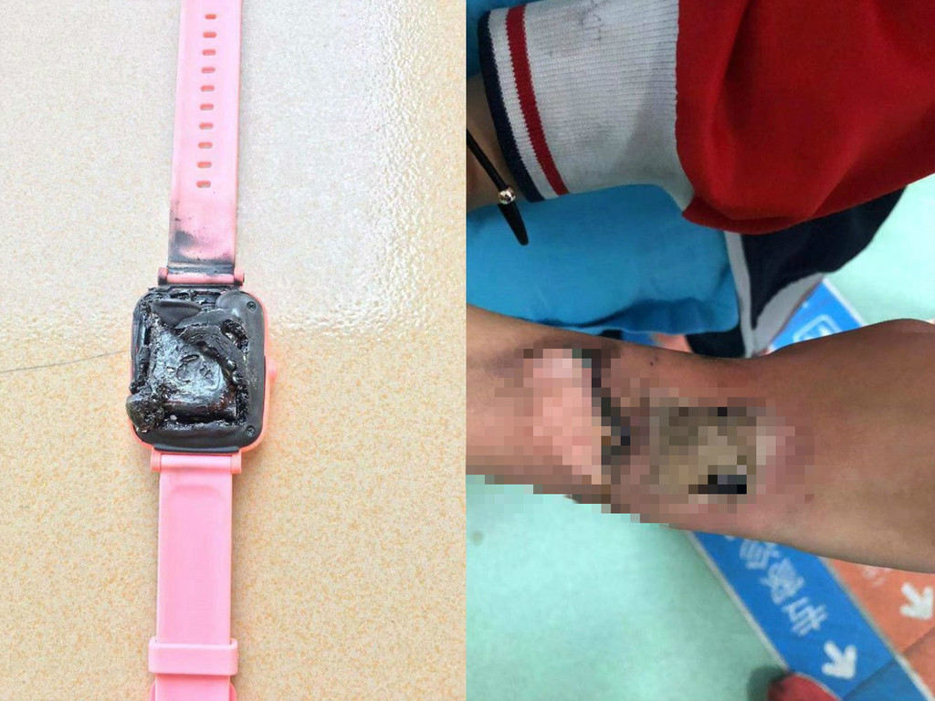 兒童智能手錶突自燃  女童手腕被燒傷