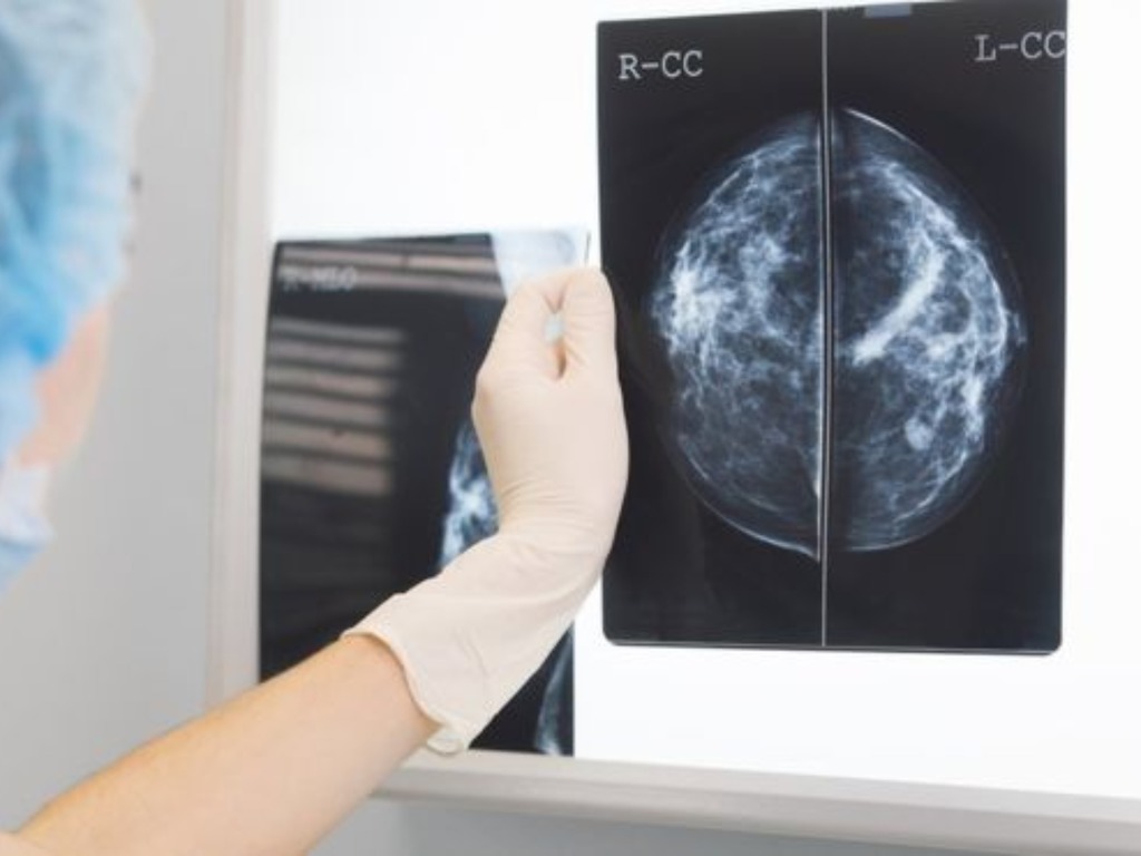研究指 AI 診斷乳癌比真正醫生更準確 誤診及漏診比率均較低