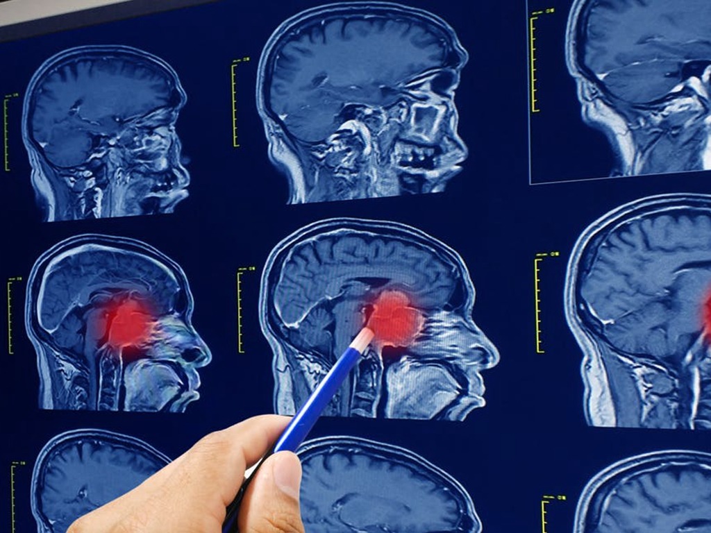 AI 診斷腦癌只需 3 分鐘  準確度高．比醫生快 10 倍