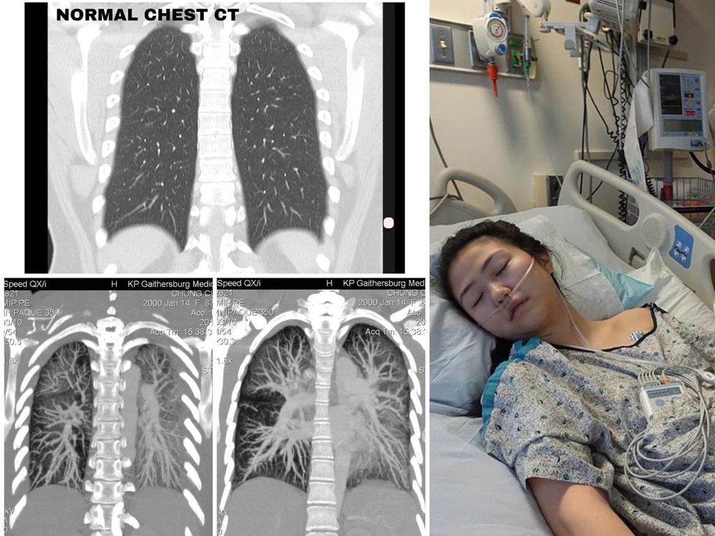 電子煙影響 19 歲美少女一生  IG 上載肺部掃描告誡世人