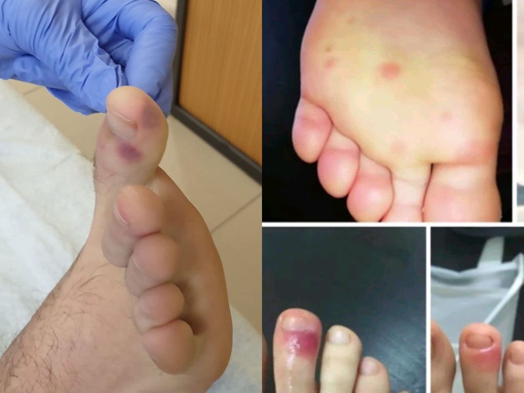 【新冠肺炎】西班牙專家新發現  腳上長紫色痘或是患病先兆