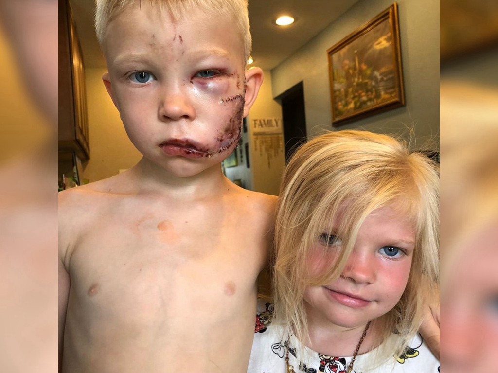 6 歲哥哥救妹遭狗咬需縫 90 針 美國隊長拍片鼓勵讚真英雄
