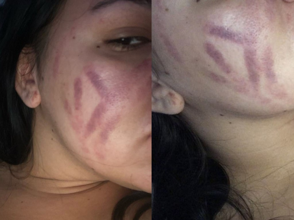 少女使用真空吸黑頭機護膚 3 分鐘後臉上現瘀痕險毀容