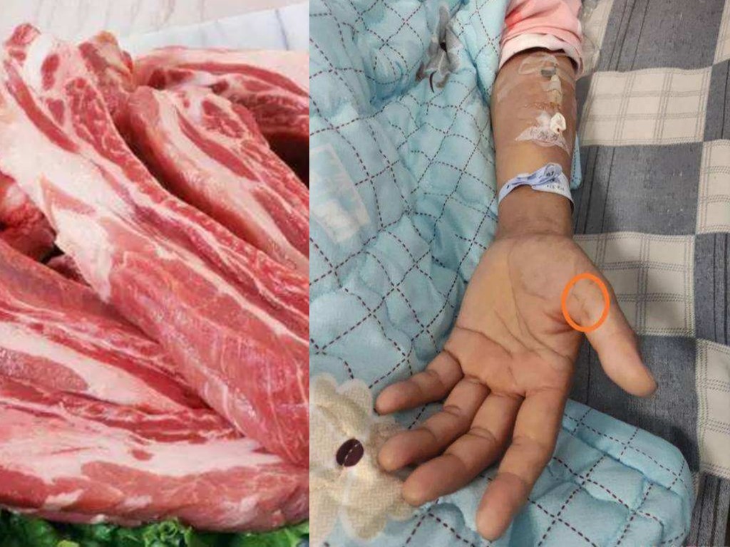 女子洗豬肉誤被碎骨刺傷  3 日後發燒確診罕見豬鏈球菌腦膜炎