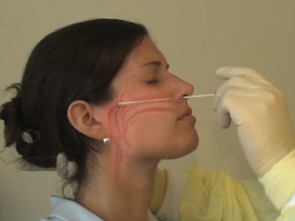 【新冠肺炎】鼻咽拭子測試出事  腦液意外流入鼻成全球首例
