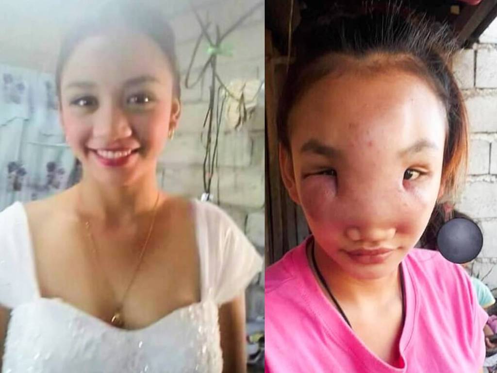 17 歲菲少女手擠黑頭竟毀容  臉部腫脹如象人致無法入睡