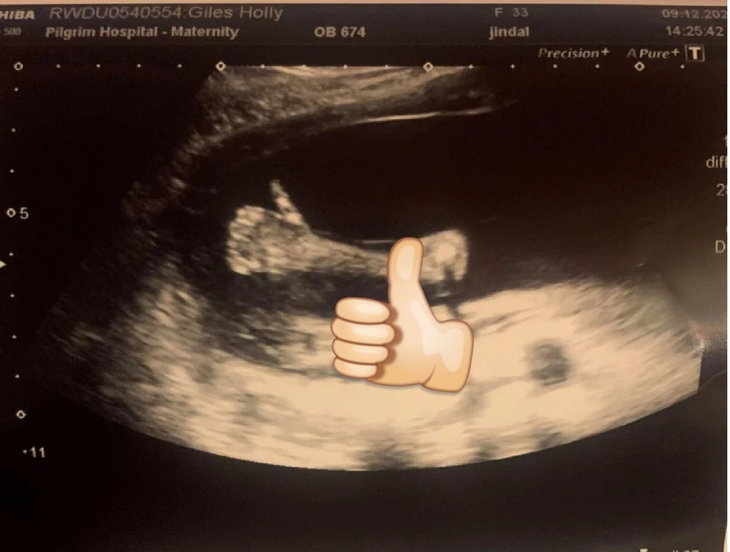 懷孕 5 個月照超聲波  胎兒擺「Like」手勢成熱話