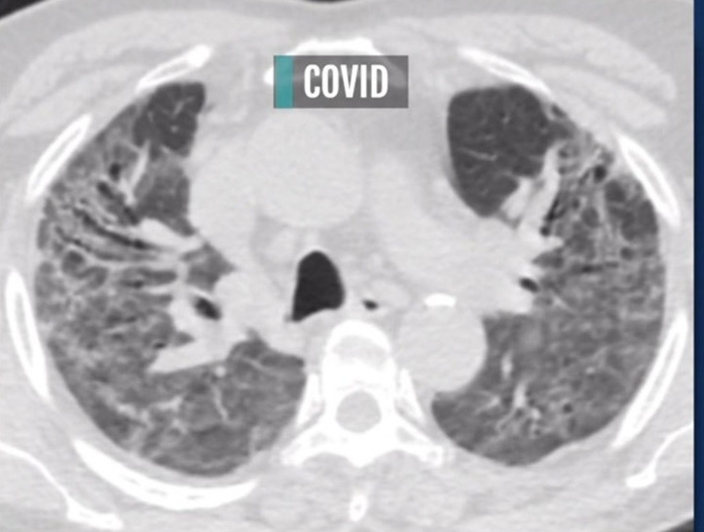 【新冠肺炎】患者肺部全花比吸煙更嚴重？ 無症狀患者肺部也會受損