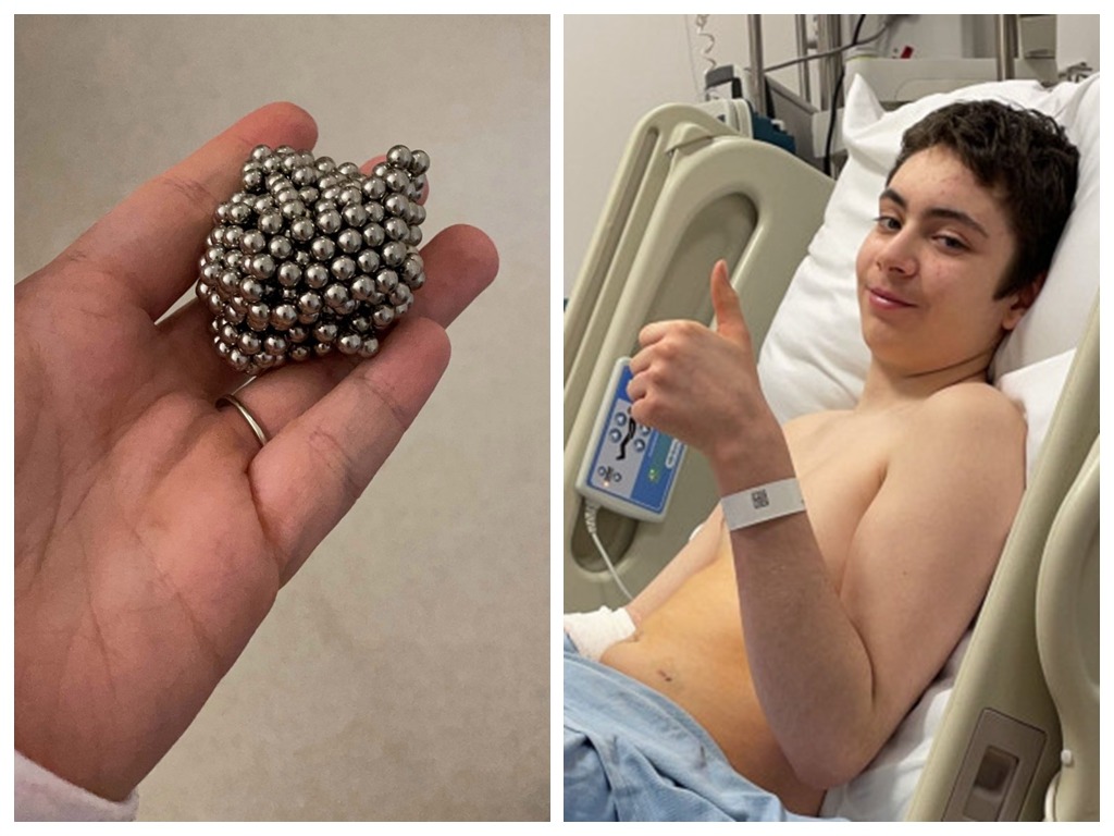 英 12 歲男童想變磁力王？ 狂吞 54 顆磁珠險死