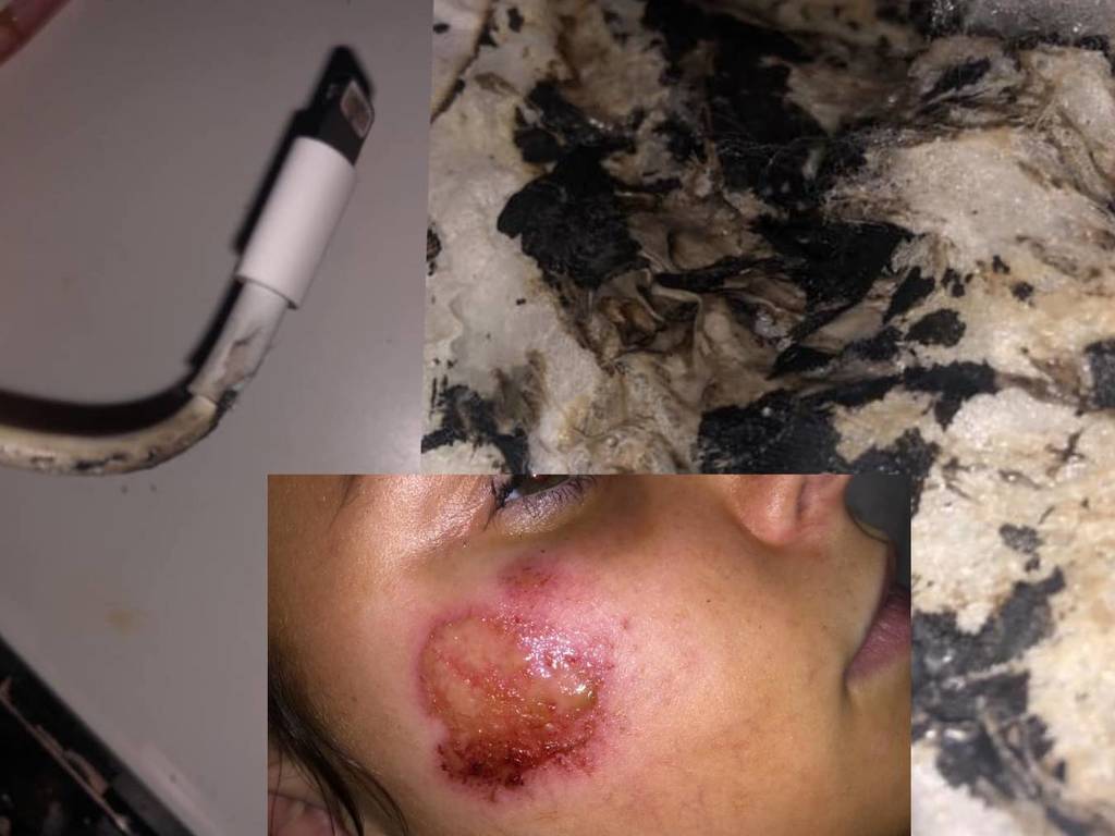 iPhone 充電過夜突起火！17 歲少女臉頰燒傷毀容