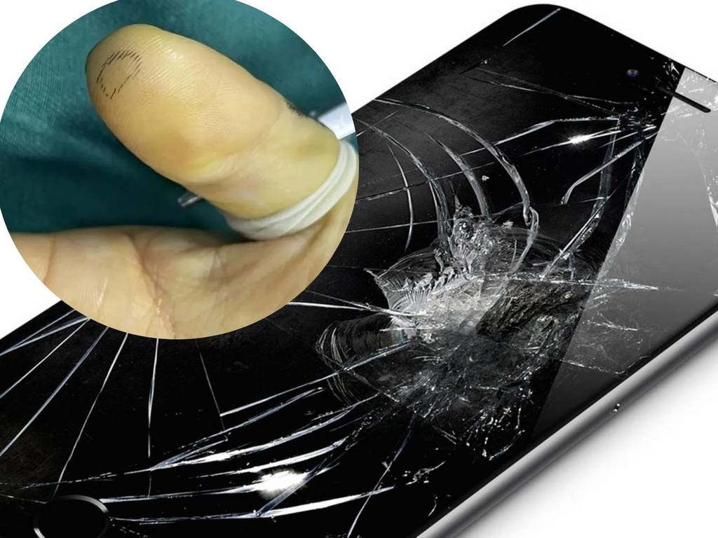 手機玻璃貼碎裂照用後果嚴重！碎片意外插入骨致增生神經瘤