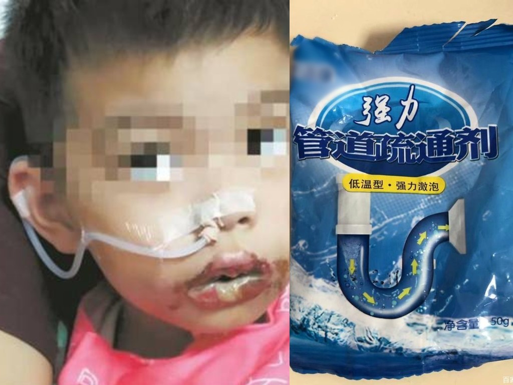 【家居意外】通渠粉亂放 4 歲童當糖食  家人急用水灌喉反致嚴重灼傷