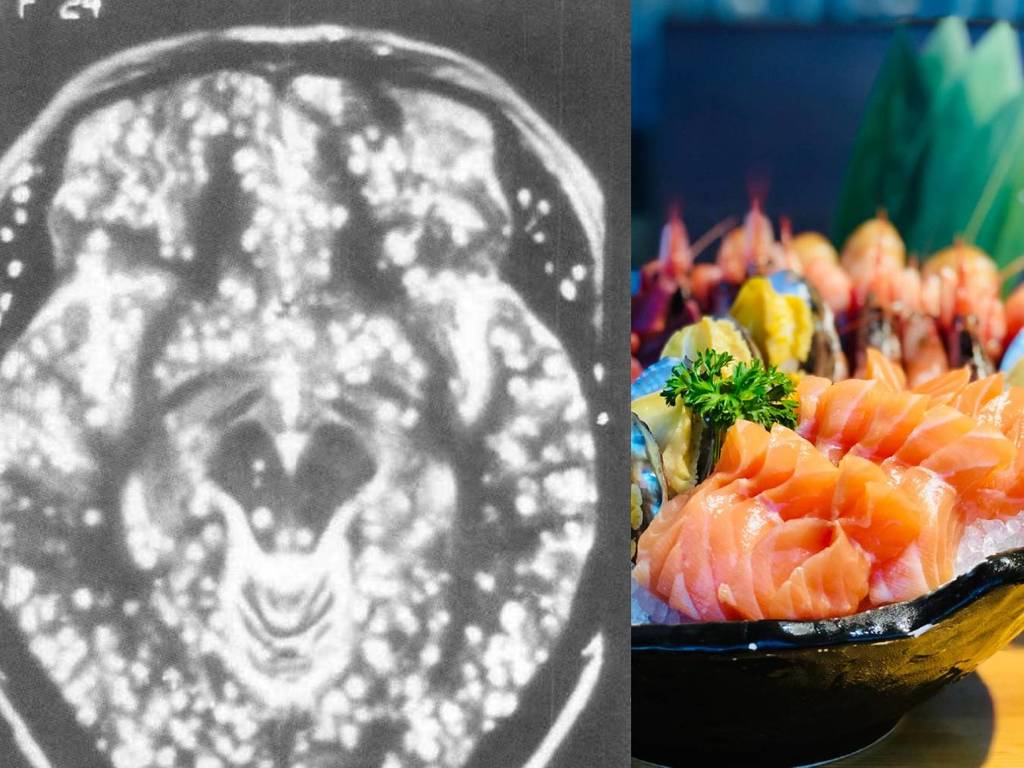 長期頭痛照 X 光像「芝麻餅」？腦內滿佈寄生蟲全因飲食習慣