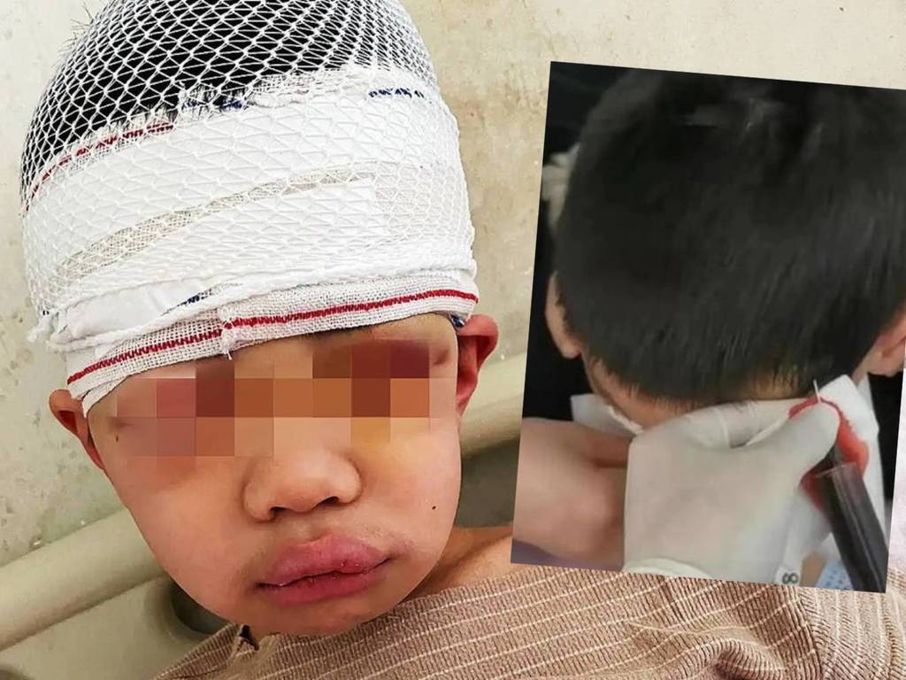 老師狠扯 9 歲童頭髮懲罰 頭皮頭骨分離需抽走 1 公升瘀血