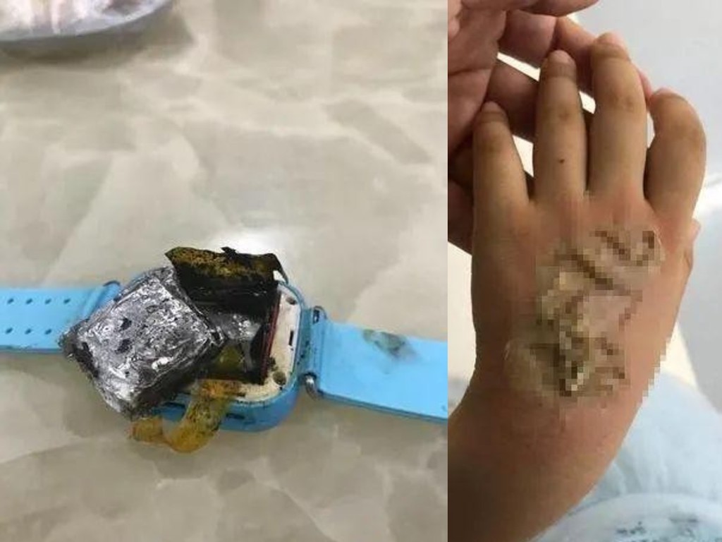 4 歲女佩戴智能手錶突爆炸  手背三度燒傷需植皮
