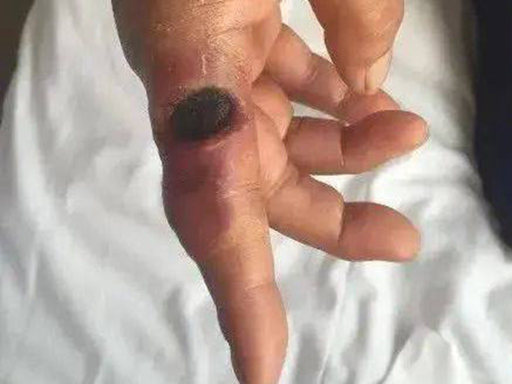 中國山西疑出現炭疽病個案  9 人皮膚變黑潰爛