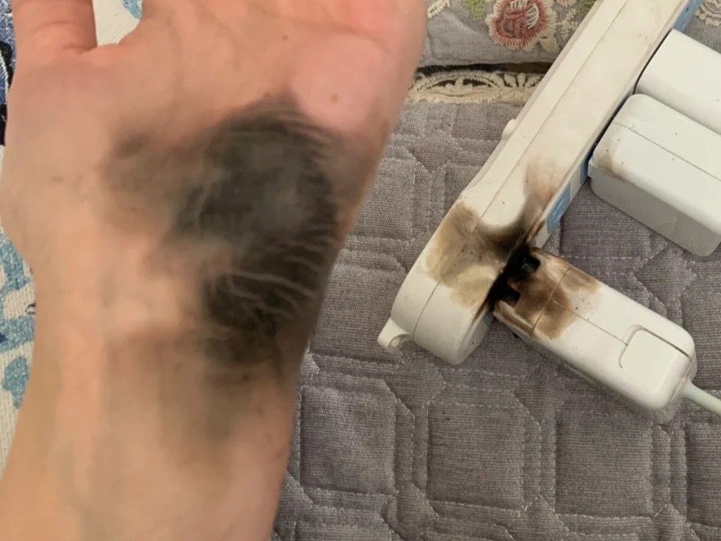 插 Apple Mac 電腦充電插頭突然爆炸 事主手部熏黑燒斷手鏈