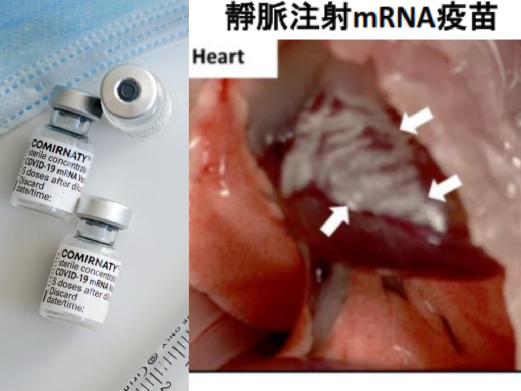 【港大研究】靜脈注射 mRNA 新冠疫苗 48 小時內  可致心肌炎及心包炎