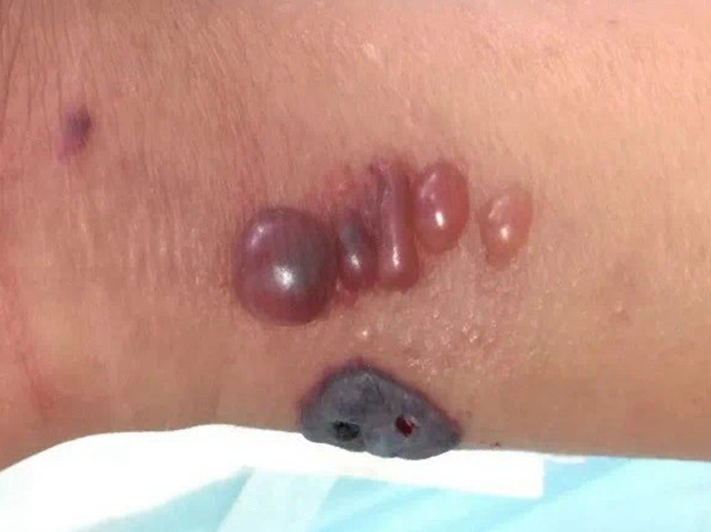 中國爆炭疽病例！1 死接觸者 4700 人！