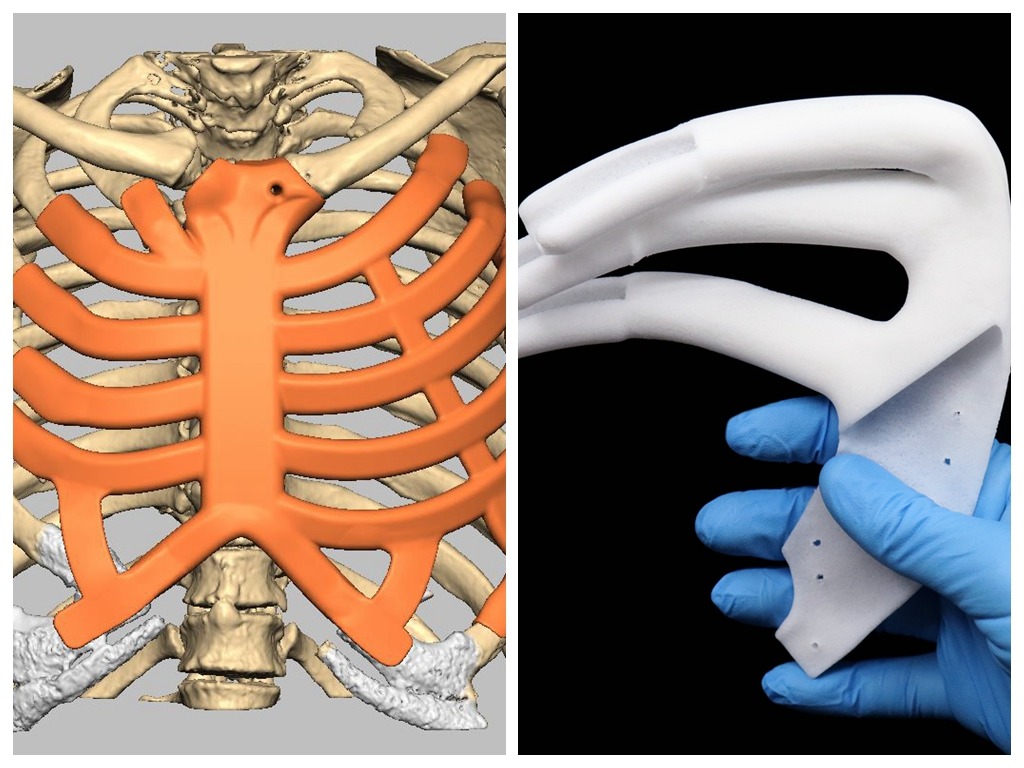 澳洲研發 3D 打印植入物重建胸腔  柔韌性佳可度身定製