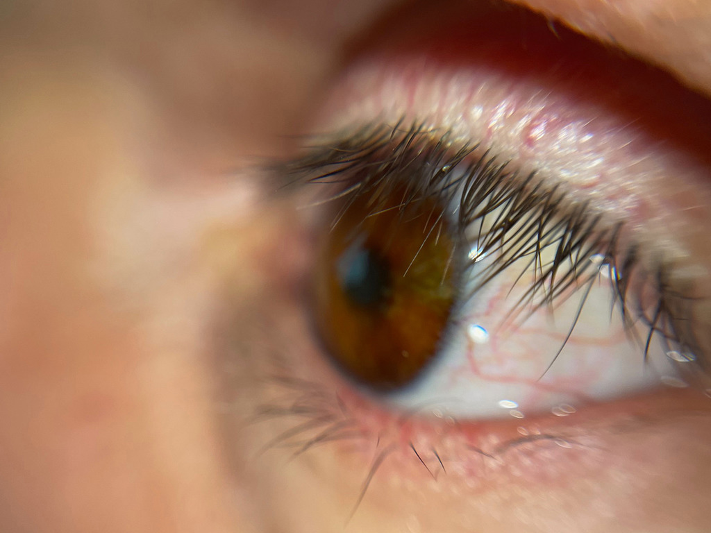 3D 打印超像真義眼 外觀與真眼無異令病人更自信