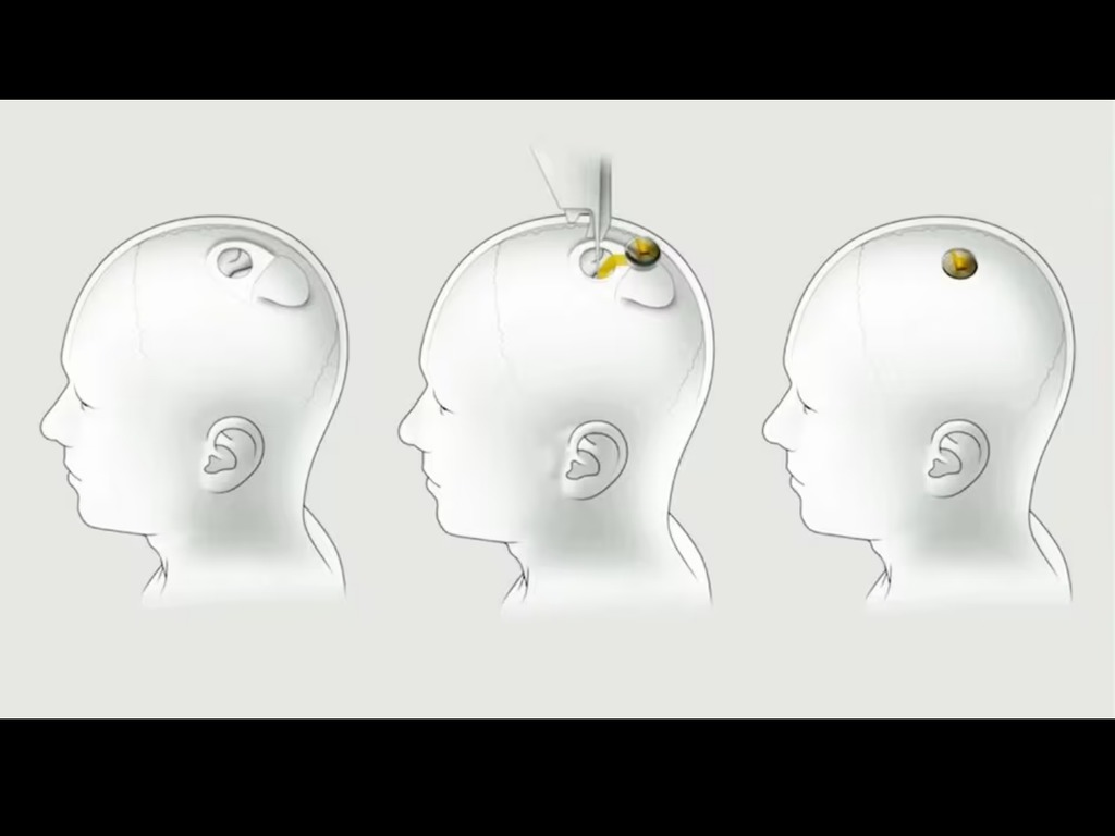 美國 FDA 拒絕 Neuralink 人體試驗 對裝置植入人腦感擔憂