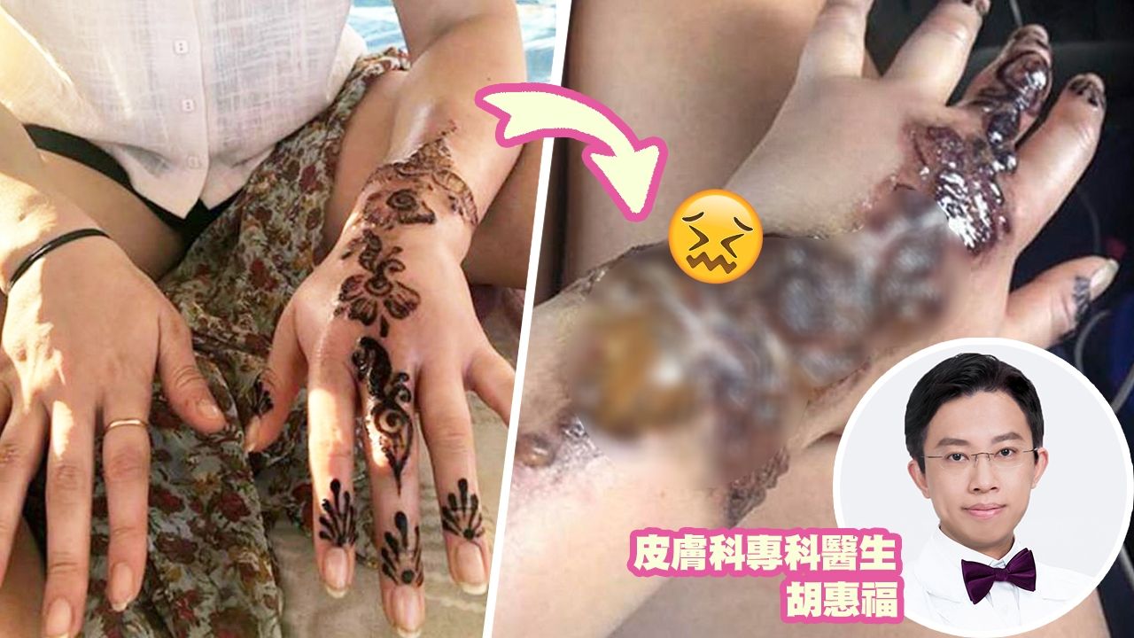 【附皮膚科醫生3大建議】澳女試玩Henna彩繪紋身 手部嚴重灼傷險截肢