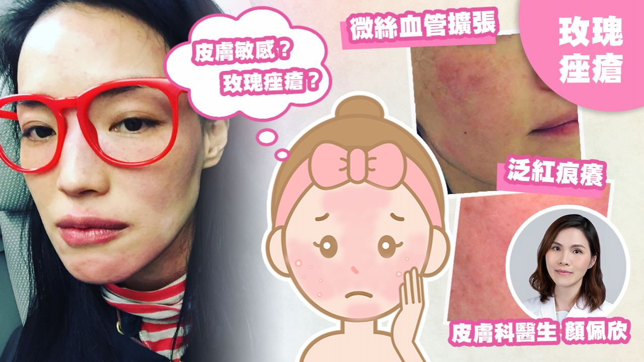 【玫瑰痤瘡】一文了解玫瑰痤瘡成因/治療方法/發病階段！皮膚科醫生：5大急救貼士