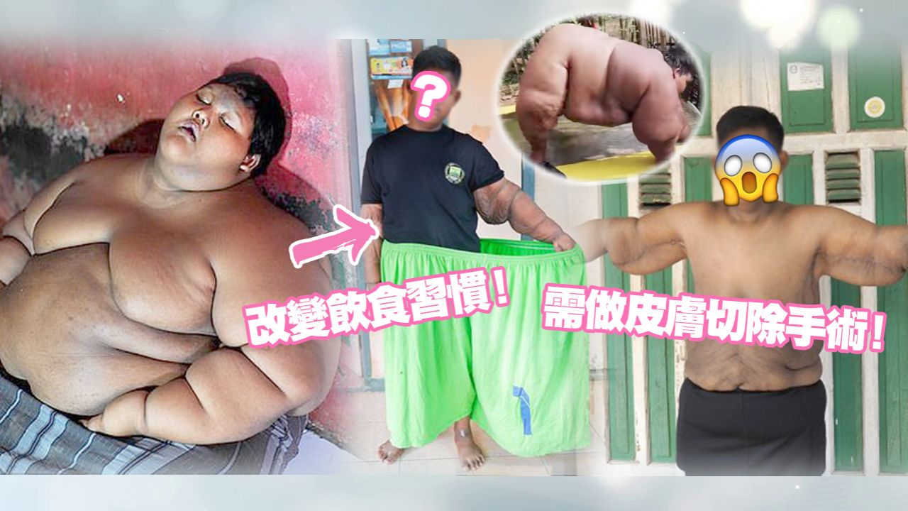 世界最胖小孩宣布減掉半個自己！成功甩肉100KG！手術後變小帥哥、網封「最強潛力股」！