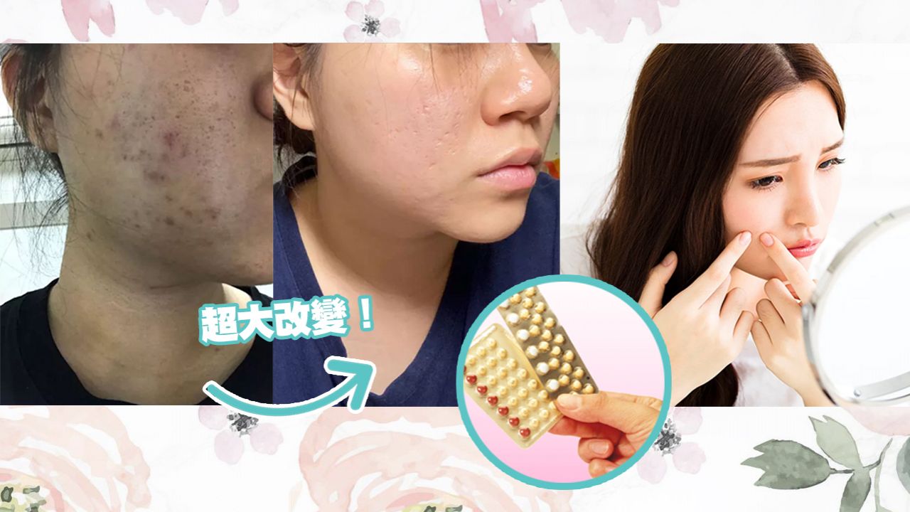 台灣網友分享「吃避孕藥」暗瘡全消心得！泛紅+紅腫痘痘也K.O！附皮膚科醫生建議！