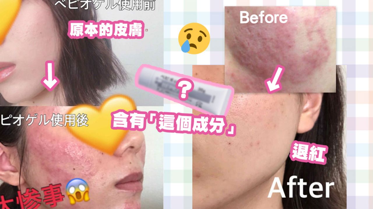 日本女生使用暗瘡膏致嚴重過敏！全臉紅腫刺痛！分享康復經歷及產品！