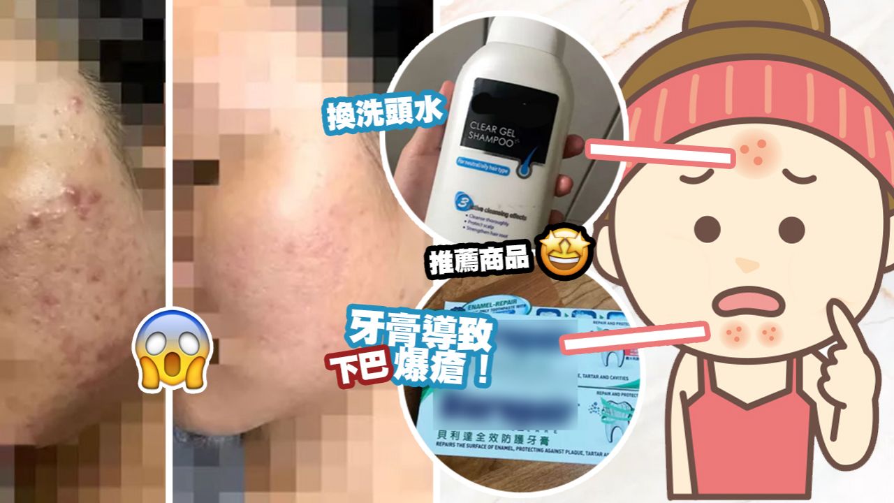 【暗瘡肌】台灣網友分享10年戰痘史！靠7招擊退頑固暗瘡！護膚程序全公開！