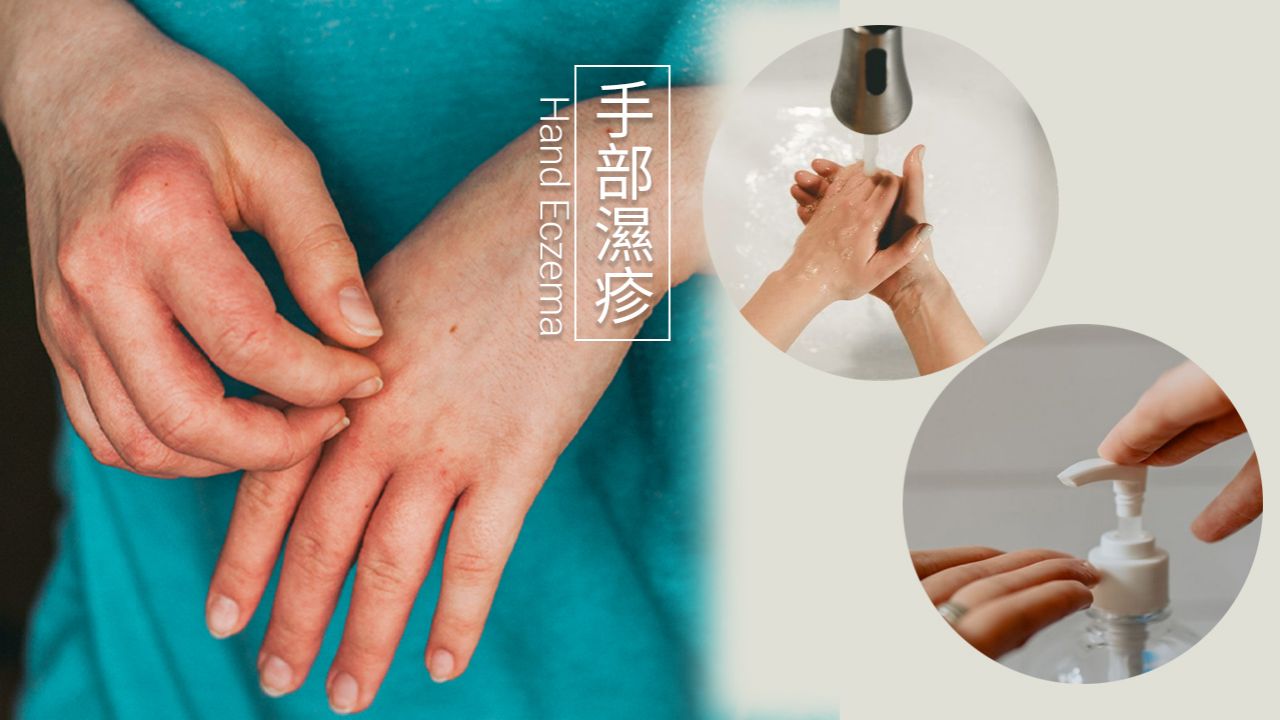 抗疫洗手導致濕疹發作？中醫分享兩大內服湯水+浸手配方！乾燥脫皮、出現紅色皮疹！