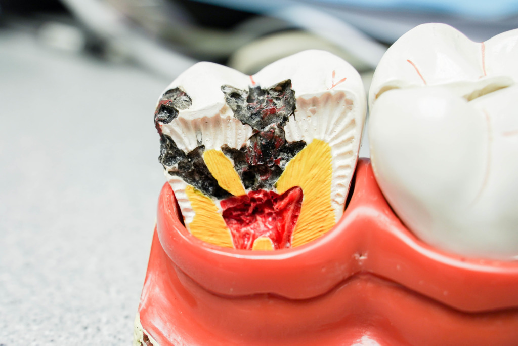 【蛀牙】牙醫超詳細蛀牙懶人包 由蛀牙成因、預防方法到正確刷牙方法