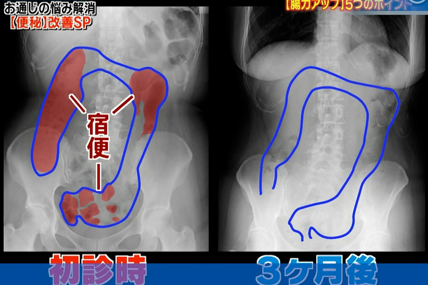 被便秘困擾40年女性大腸塞滿宿便！　日本醫生推薦5個簡單方法快速改善腸道力／3個月見效