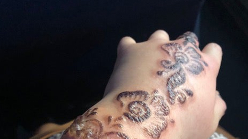 澳洲女旅行玩Henna紋身細菌感染