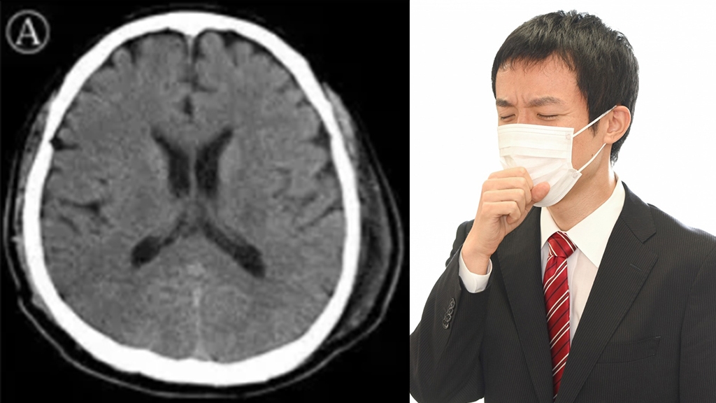 北京醫院證實疫症會併發腦炎