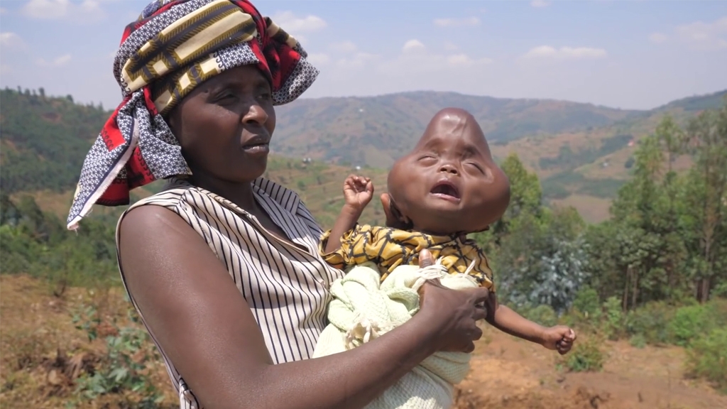 非洲媽媽誕尖頭畸形兒遭拋棄