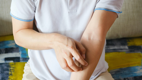 男子食龍蝦堡全身起疹兼呼吸困難 醫生：過敏恐另有原因