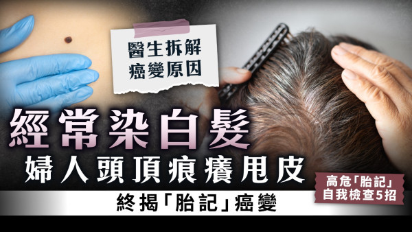 染頭髮傷害｜經常染白髮 婦人頭頂痕癢甩皮終揭「胎記」癌變【醫生拆解】