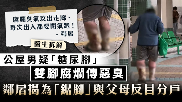 糖尿腳｜公屋男疑「糖尿腳」腐爛傳惡臭 鄰居揭為「鋸腳」與父母反目分戶【醫生拆解】