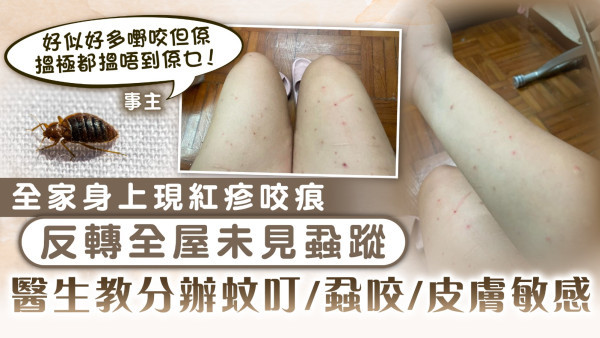 床蝨疑雲｜全家身上現紅疹咬痕 反轉全屋未見蝨蹤 醫生教分辦蚊叮/蝨咬/皮膚敏感　