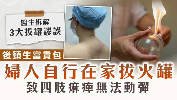 拔罐風險｜後頸生富貴包 在家做拔火罐祛濕 婦人四肢痲痺無法動彈送院