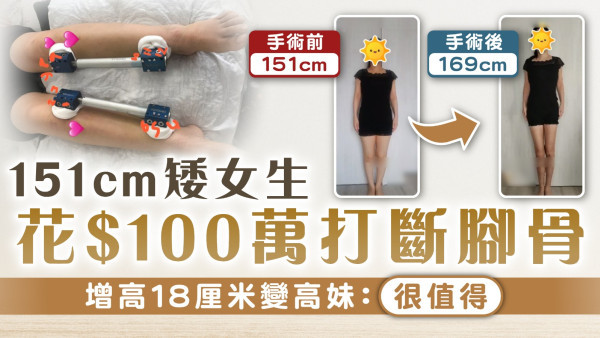 增高手術｜151cm矮女花$100萬打斷腳骨 增高18厘米變高妹：很值得