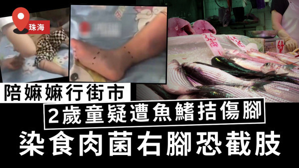 食肉菌｜陪嫲嫲行街市2歲童疑遭魚鰭拮傷腳　染食肉菌右腳恐截肢