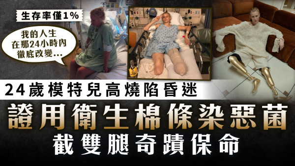 女性健康｜24歲模特兒高燒陷昏迷 證用衛生棉條染惡菌 截雙腿奇蹟保命
