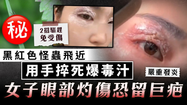 隱翅蟲注意｜黑紅色怪蟲飛近 用手捽死爆毒汁 女子眼部灼傷恐留巨疤