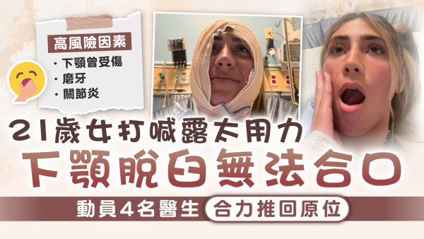 下巴脫臼｜21歲女打喊露太用力 下顎脫臼無法合口 動員4名醫生合力推回原位