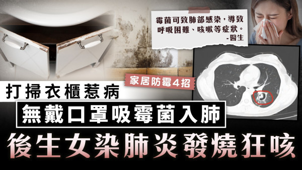 傢俬發霉｜打掃衣櫃惹病 無戴口罩吸霉菌入肺 後生女染肺炎發燒狂咳