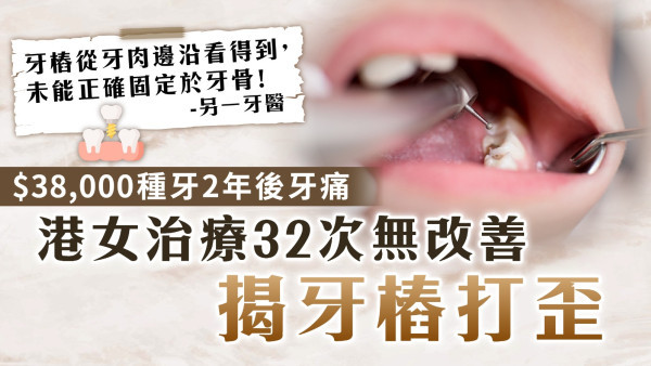 睇牙中伏｜$38,000種牙2年後牙痛 港女治療32次無改善揭牙樁打歪